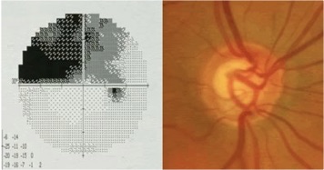 glaucoma_exam.jpg