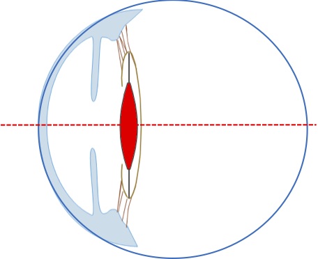 ametropia.jpg
