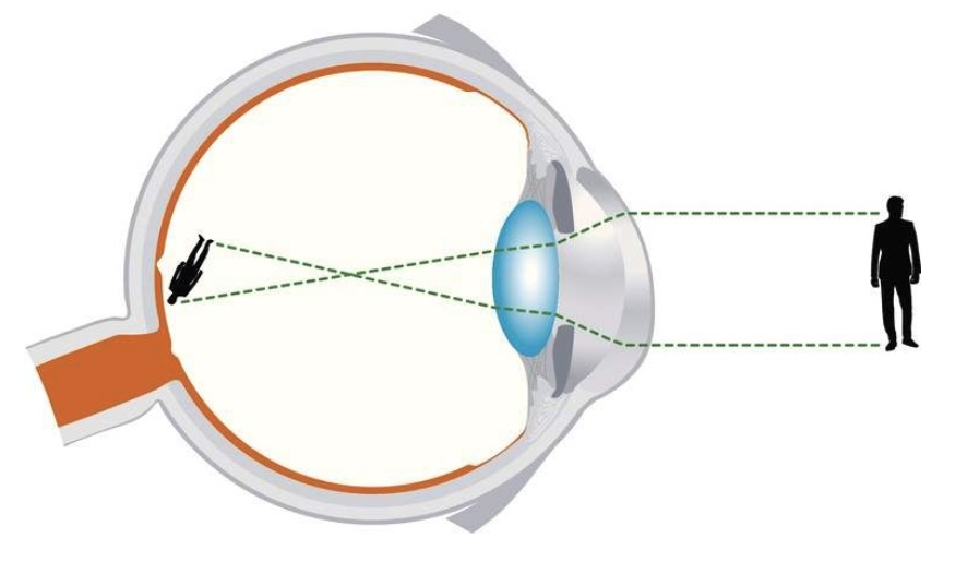 astigmatism2.jpg