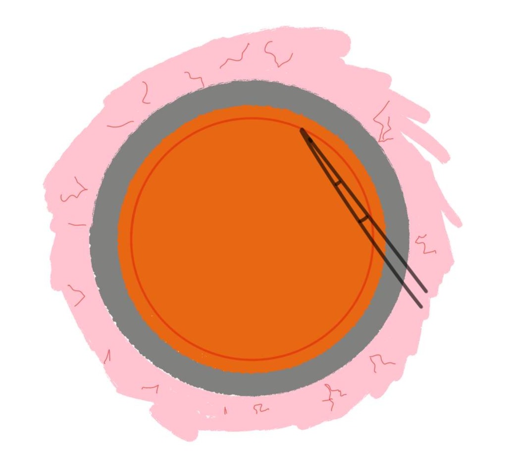 capsuilorhexis_edited.jpg